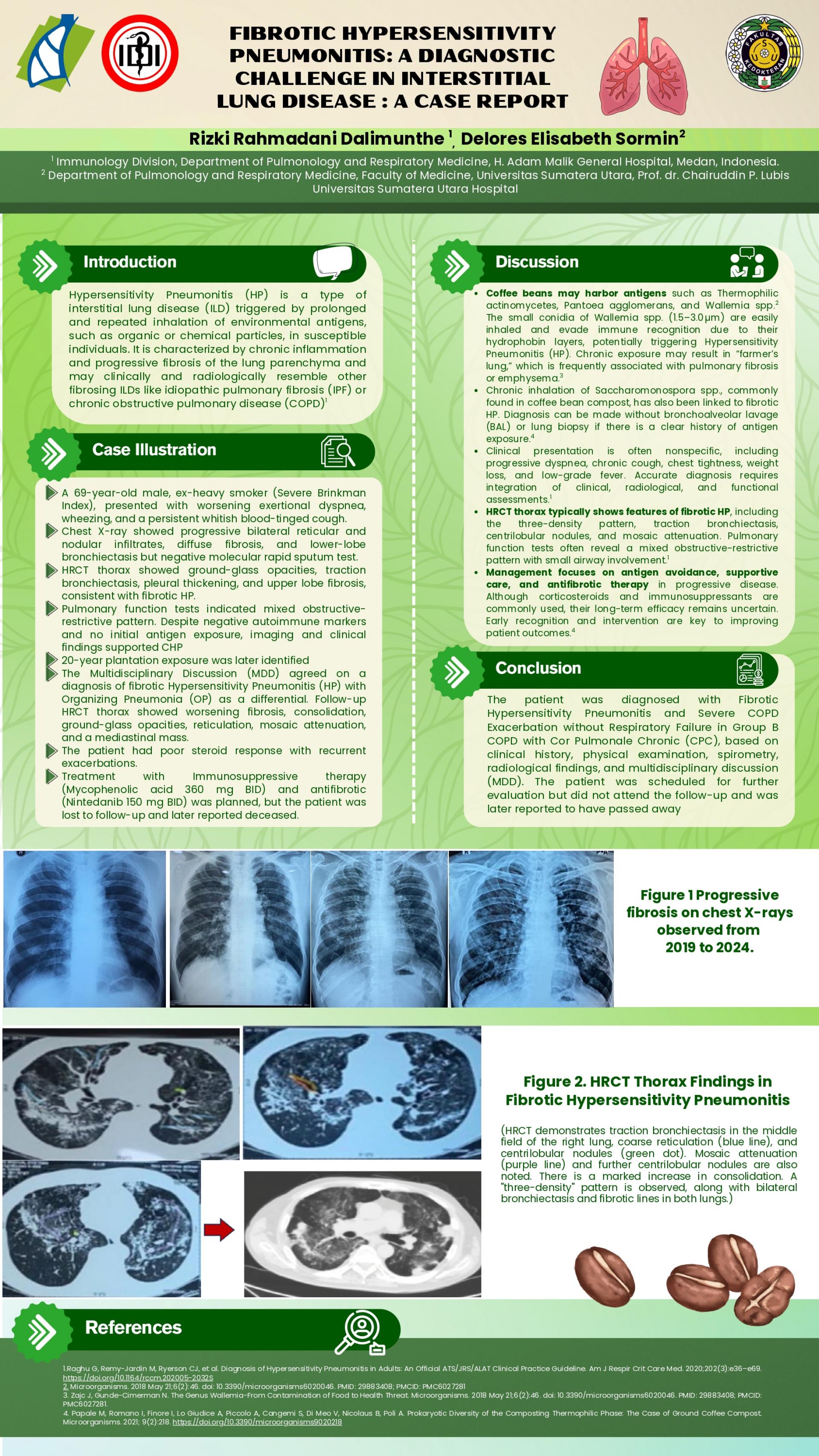 FIBROTIC HYPERSENSITIVITY PNEUMONITIS: A DIAGNOSTIC CHALLENGE IN INTERSTITIAL LUNG DISEASE : A CASE REPORT