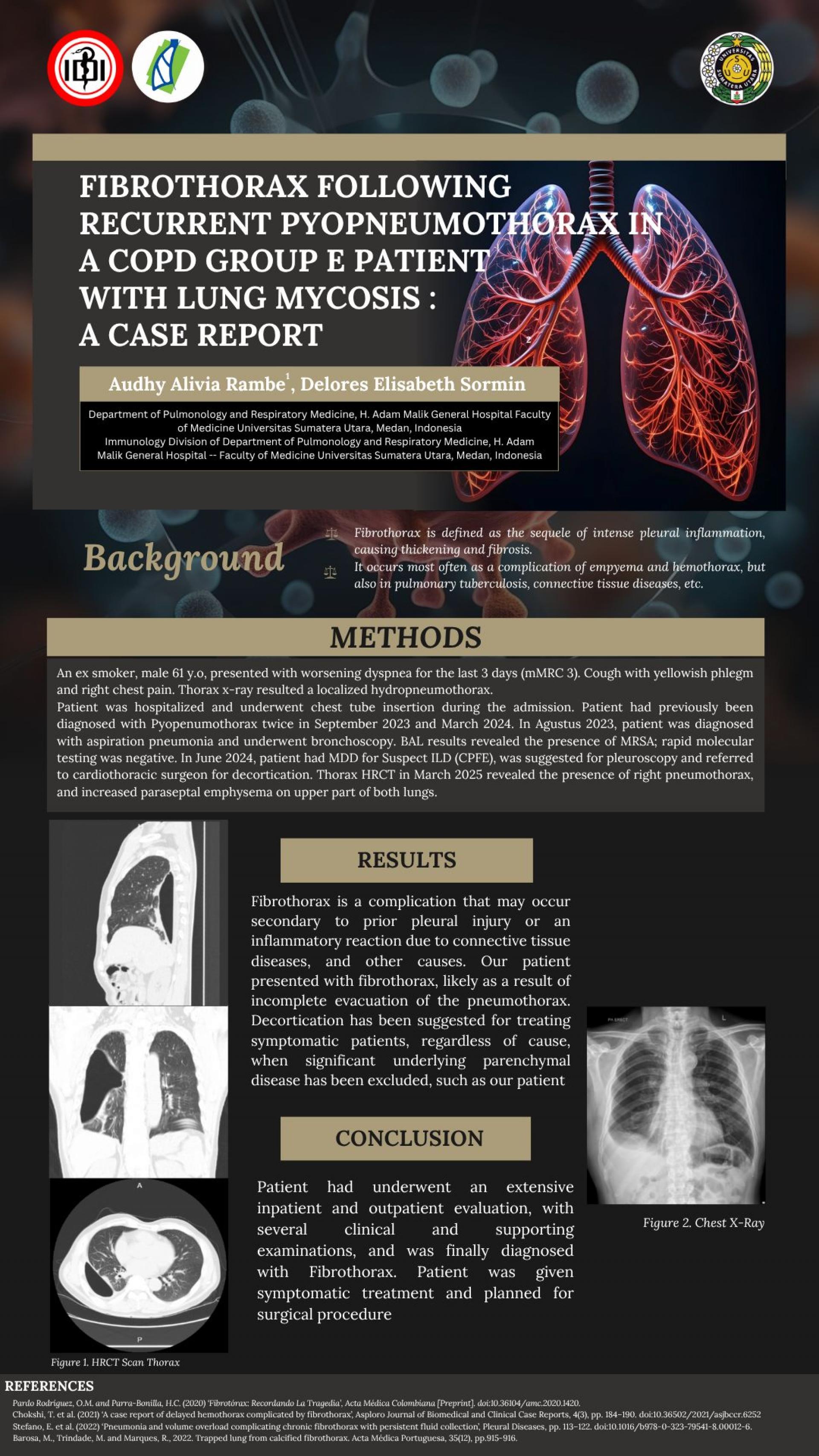 FIBROTHORAX FOLLOWING RECURRENT PYOPNEUMOTHORAX IN A COPD GROUP E PATIENT WITH LUNG MYCOSIS: A CASE REPORT